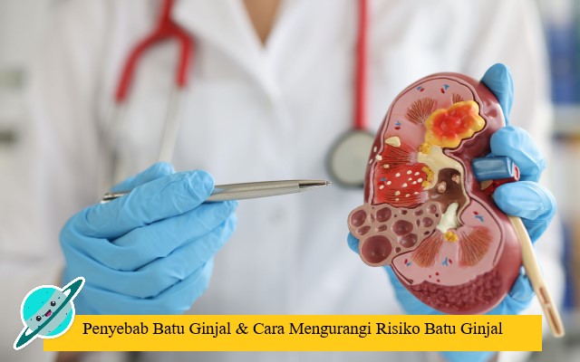 Penyebab Batu Ginjal & Cara Mengurangi Risiko Batu Ginjal